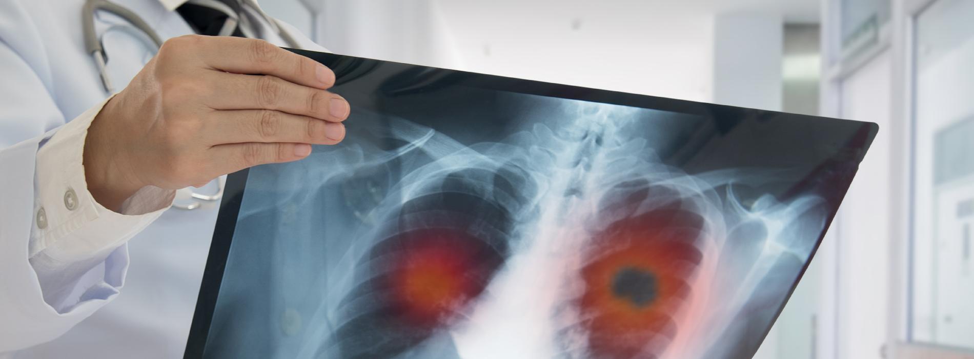 Przewlekła obturacyjna choroba płuc — objawy, przyczyny, leczenie