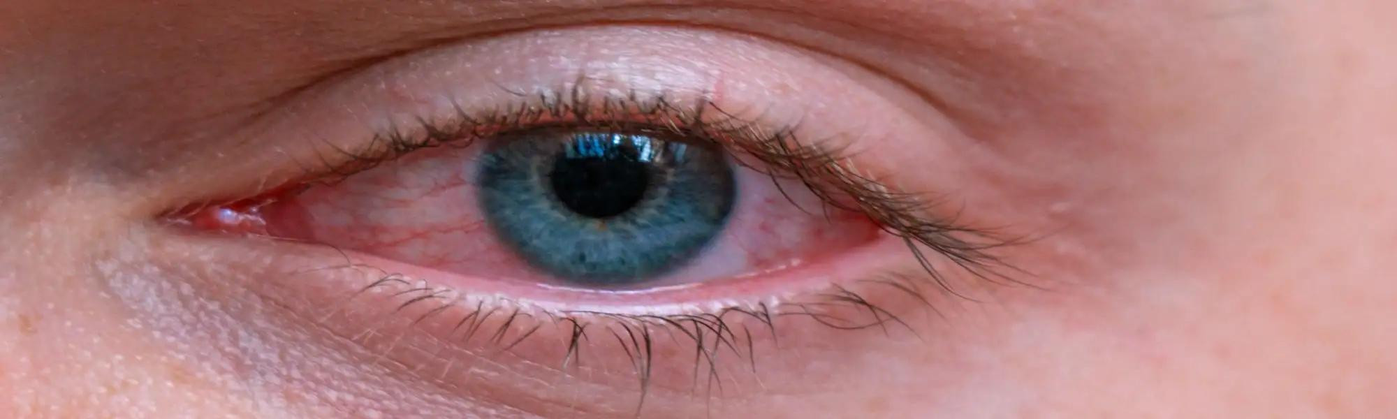 Zapalenie twardówki — czym jest? Objawy, rodzaje, przyczyny, diagnostyka i leczenie