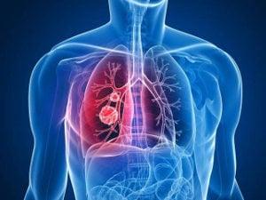 Rak płuca - przyczyny, objawy, diagnostyka, leczenie i profilaktyka