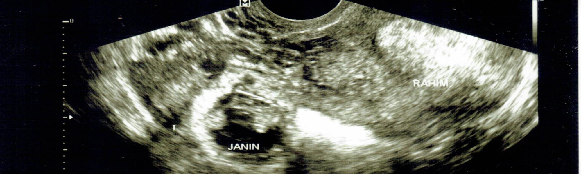 Ciąża pozamaciczna - przyczyny, objawy, leczenie