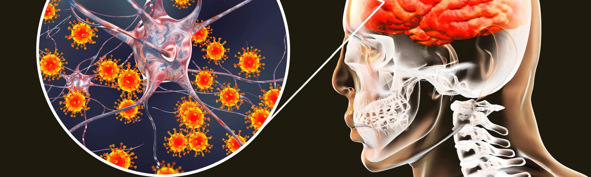Zapalenie opon mózgowych — objawy. Kleszczowe, opryszczkowe, wirusowe a bakteryjne zapalenia opon mózgowych i mózgu