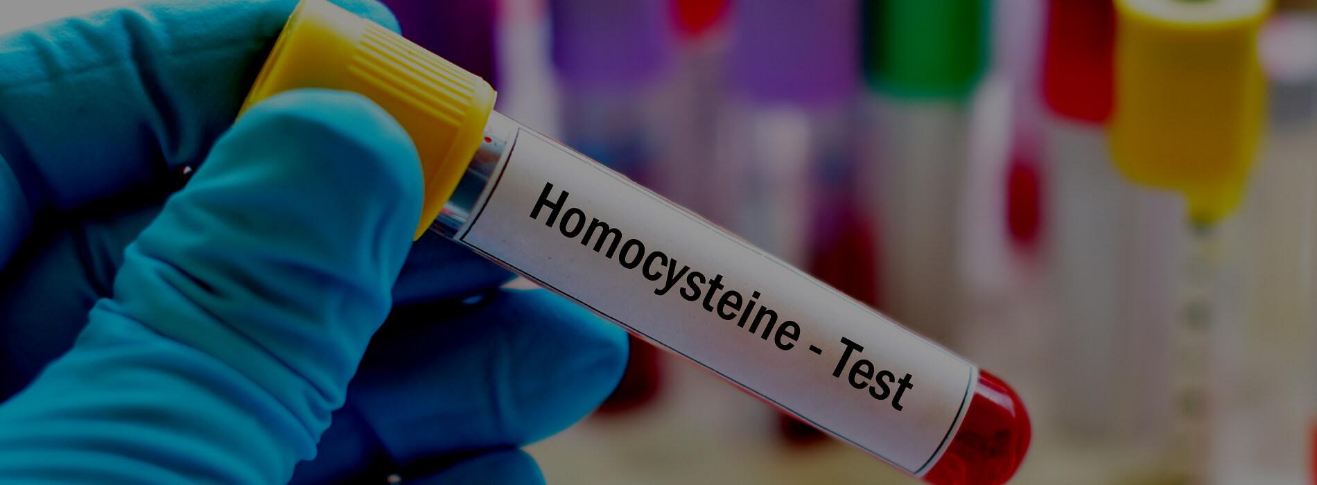 Kiedy warto wykonać badanie poziomu homocysteiny? O czym świadczy wysoki poziom?
