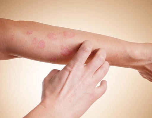 Atopowe zapalenie skóry - przyczyny, objawy i leczenie AZS